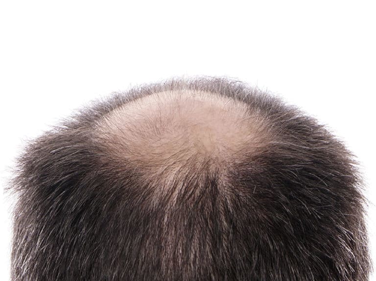 Autotrapianto capelli con tecnica FUE Chirurgia Plastica Catania