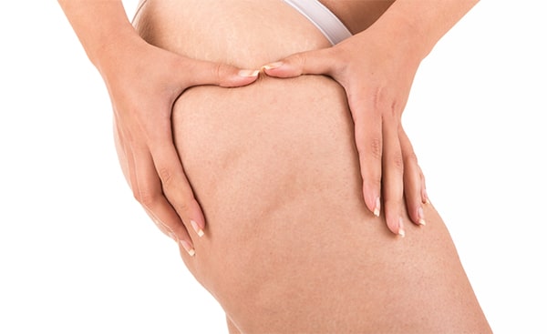 MC1 trattamento della cellulite