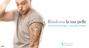 Scopri di più sull'articolo Pentiti del tatuaggio? Rimozione facile e indolore con laser treatment.