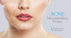 Scopri di più sull'articolo Cicatrici da acne? Vivace, il nuovo trattamento che rigenera la pelle