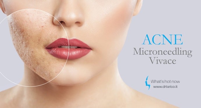 Scopri di più sull'articolo Cicatrici da acne? Vivace, il nuovo trattamento che rigenera la pelle