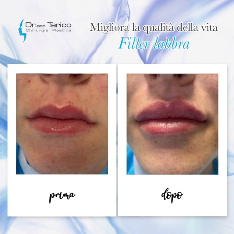 Prima E Dopo Filler Chirurgia Plastica Catania Sicilia