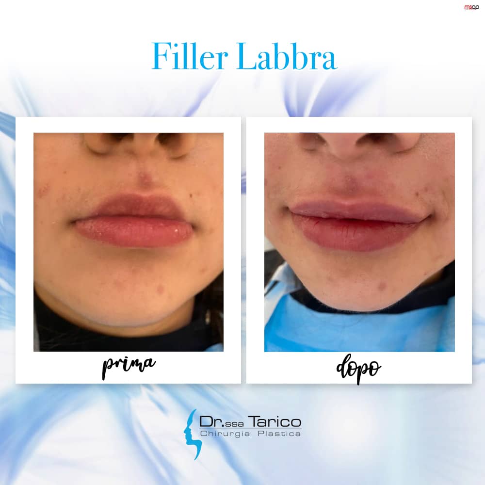 filler labbra catania