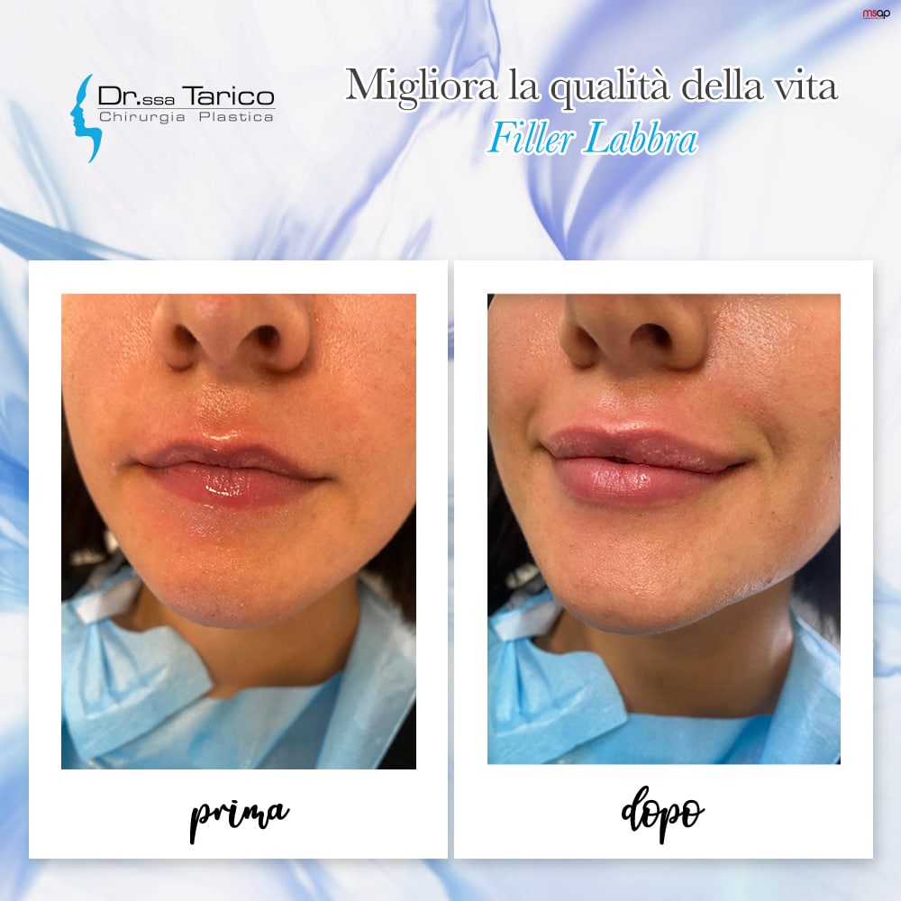 Filler Labbra Catania