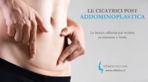 Scopri di più sull'articolo Le cicatrici post Addominoplastica