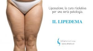 Scopri di più sull'articolo Liposuzione, la cura risolutiva per il Lipedema