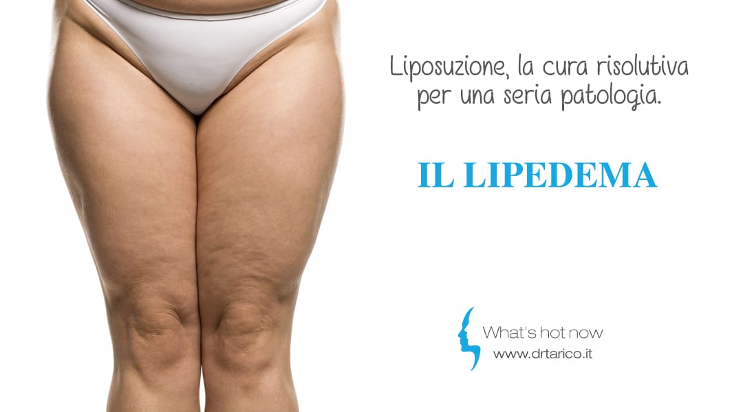 Al momento stai visualizzando Liposuzione, la cura risolutiva per il Lipedema