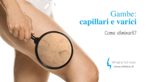 Scopri di più sull'articolo Gambe: capillari e varici, come eliminarli?