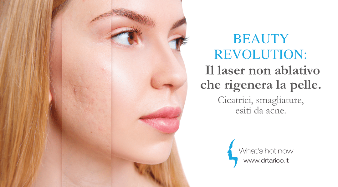 Beauty Revolution: il laser non ablativo che rigenera la pelle cicatrici, smagliature, esiti da acne e rughe