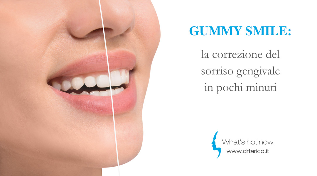 Gummy smile: la correzione del sorriso gengivale in pochi minuti