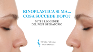 Scopri di più sull'articolo Rinoplastica sì ma… cosa succede dopo?