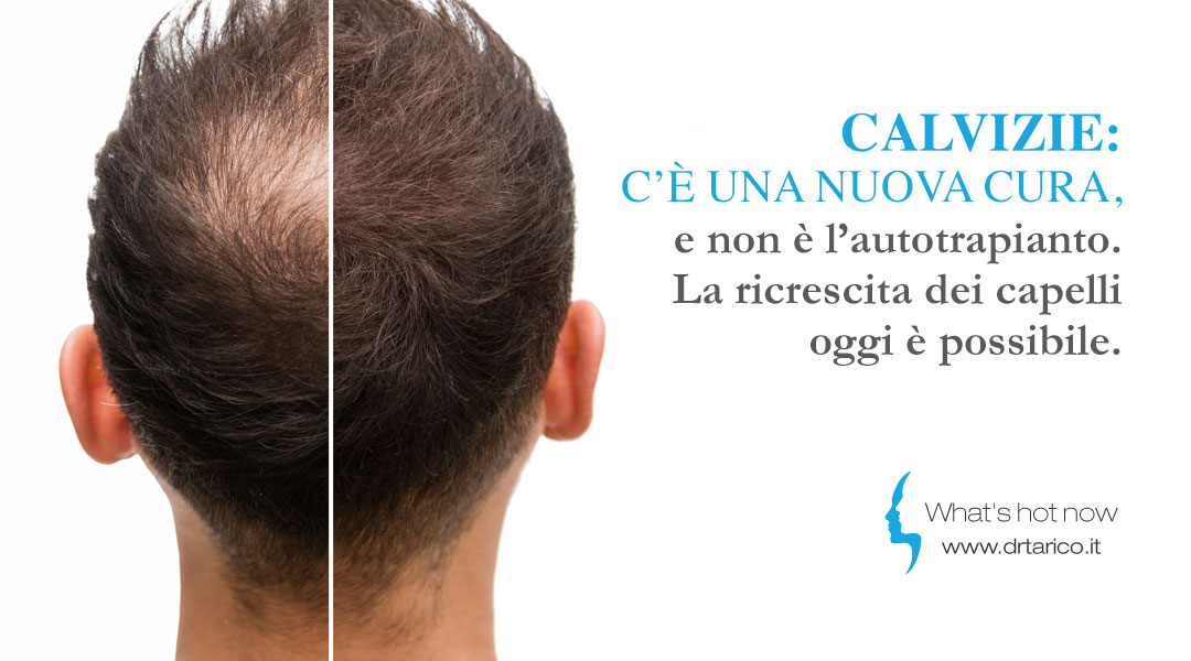Al momento stai visualizzando Calvizie: c’è una nuova cura, e non è l’autotrapianto. 