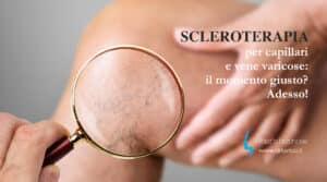 Scopri di più sull'articolo Scleroterapia per capillari e vene varicose: il momento giusto? Adesso!