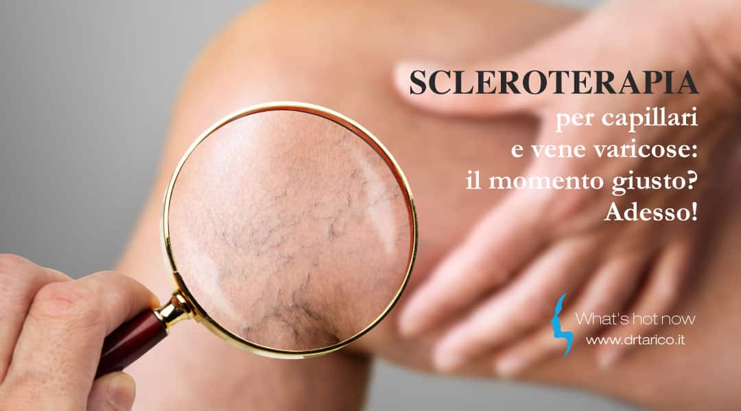 Al momento stai visualizzando Scleroterapia per capillari e vene varicose: il momento giusto? Adesso!