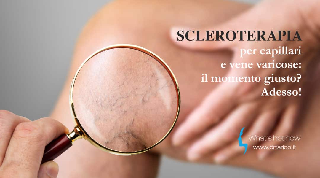 Al momento stai visualizzando Scleroterapia per capillari e vene varicose: il momento giusto? Adesso!