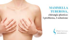 Scopri di più sull'articolo Mammella tuberosa, chirurgia plastica: 1 problema, 1 soluzione