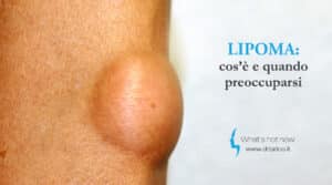 Scopri di più sull'articolo Lipoma: cos’è e quando preoccuparsi