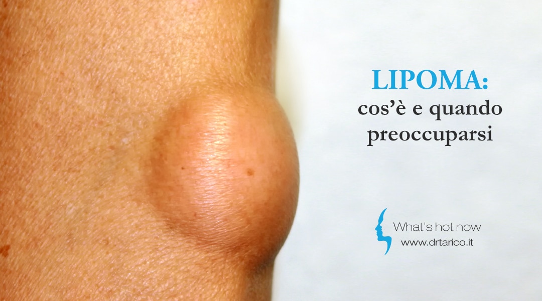 Al momento stai visualizzando Lipoma: cos’è e quando preoccuparsi