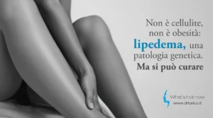 Scopri di più sull'articolo Non è cellulite, non è obesità: Lipedema, una patologia genetica. Ma si può curare