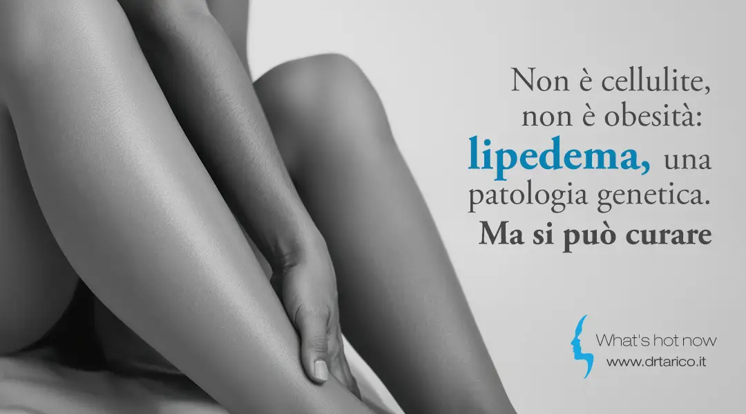 Al momento stai visualizzando Non è cellulite, non è obesità: Lipedema, una patologia genetica. Ma si può curare