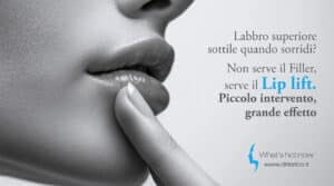 Scopri di più sull'articolo Labbro superiore sottile quando sorridi? Non serve il Filler, serve il Lip lift. Piccolo intervento, grande effetto
